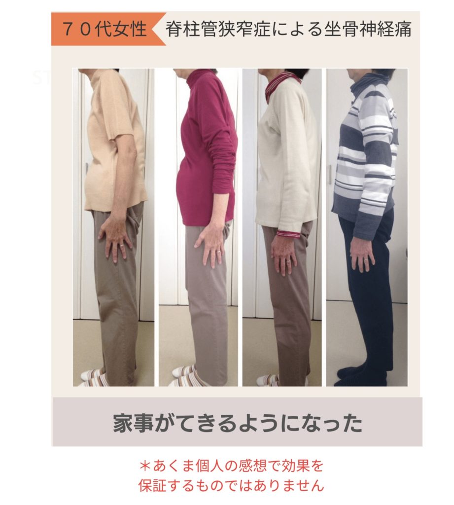 脊柱管狭窄症による坐骨神経痛で歩行困難ビフォーアフター