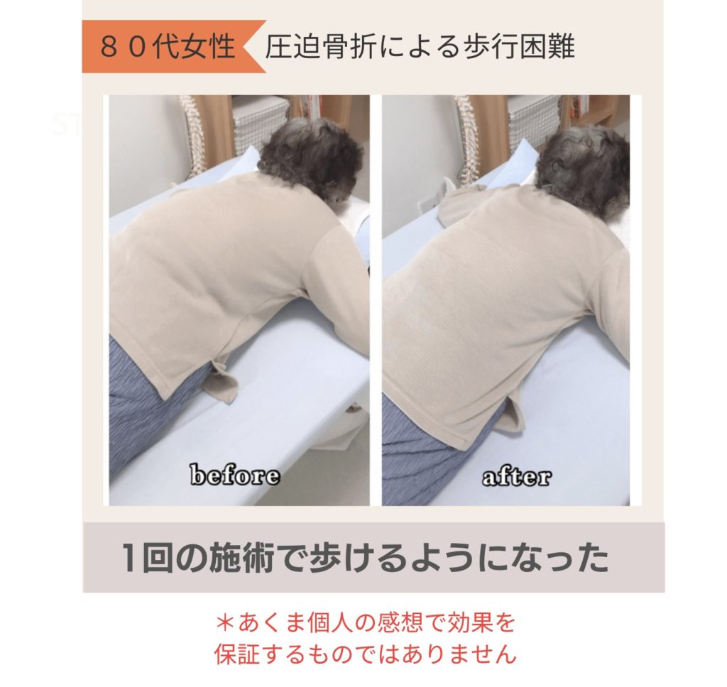 脊柱管狭窄症による歩行困難でビフォーアフター